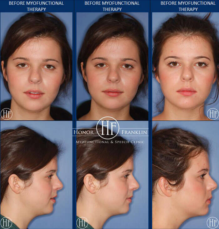 Success Stories Photo Gallery Honor Franklin Myofunctional & Speech