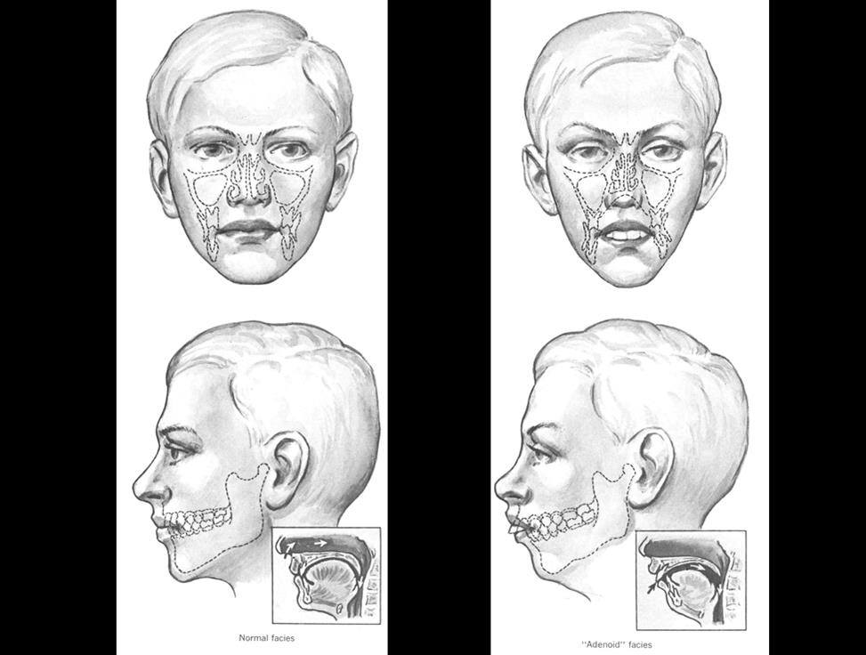 The Negative Effects Of Mouth Breathing Honor Franklin